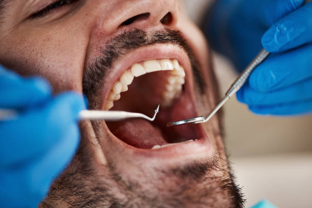 Dental Inlays and Onlays in Fairfield, IL